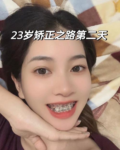 23岁可以矫正牙齿-图3 23岁可以矫正牙齿-图3