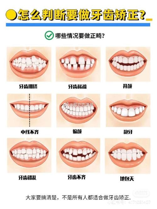 牙齿矫正过程图片能直观看清哪些牙齿变化步骤？-图2