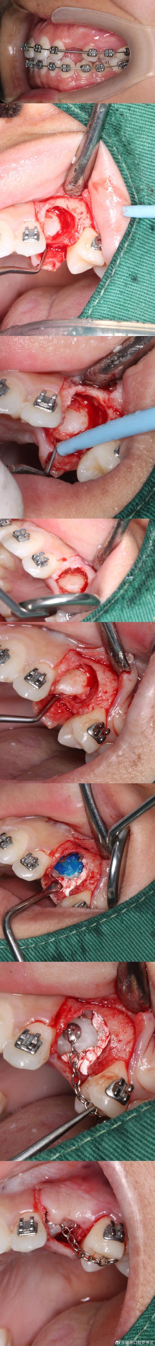 成人拔牙矫正，是否必须拔牙？效果与风险有哪些需要注意的？-图3