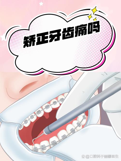 牙齿矫正戴牙套痛吗?多久能缓解?-图1 牙齿矫正戴牙套痛吗?多久能缓解?-图1