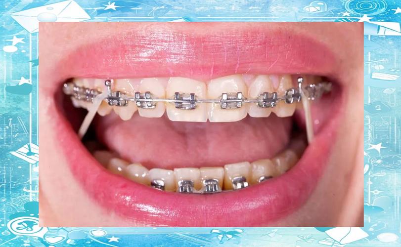 金属托槽矫正牙齿效果如何？优缺点有哪些？-图2