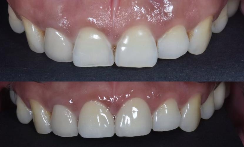 美容冠矫正牙齿的具体过程是怎样的？-图3