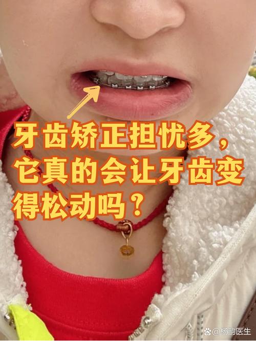 牙齿矫正会让牙齿松动吗?-图1 牙齿矫正会让牙齿松动吗?-图1