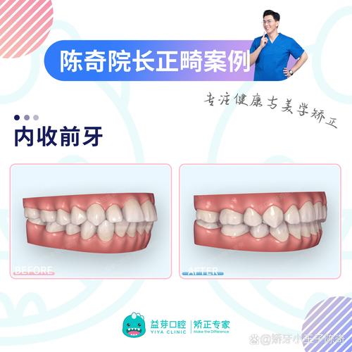 广州矫正牙齿哪里好？求推荐靠谱机构或医生？-图3