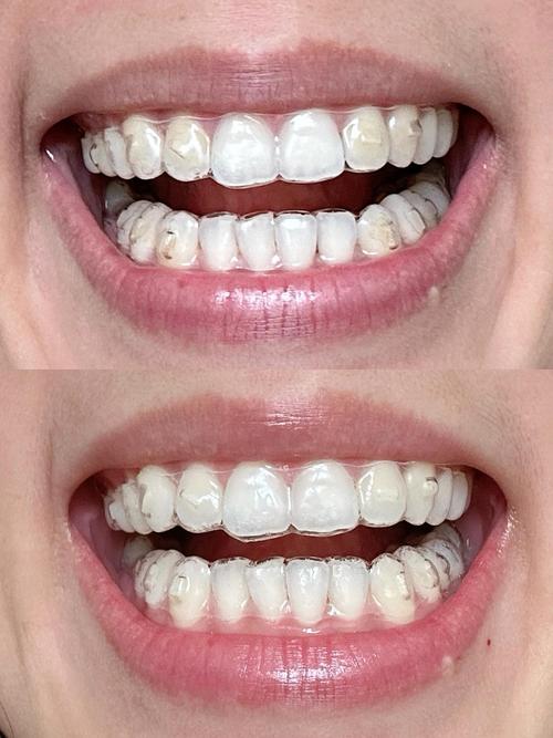 隐形牙套矫正效果如何？值得选吗？-图1