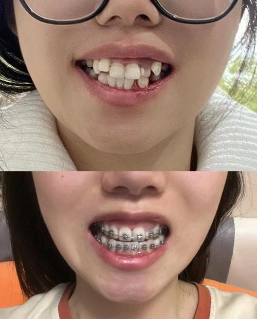 上海医院牙齿矫正哪家好？效果怎样？价格贵不贵？-图1