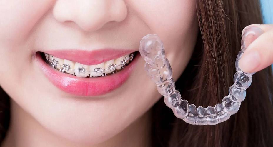 矫正牙齿选牙套，哪种更适合自己？-图1