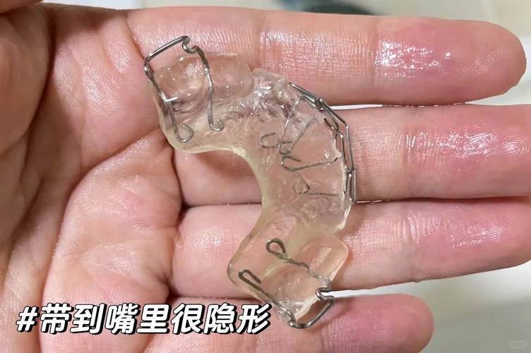 轻微天包地牙齿矫正,有必要做吗?效果如何?-图1 轻微天包地牙齿矫正,有必要做吗?效果如何?-图1