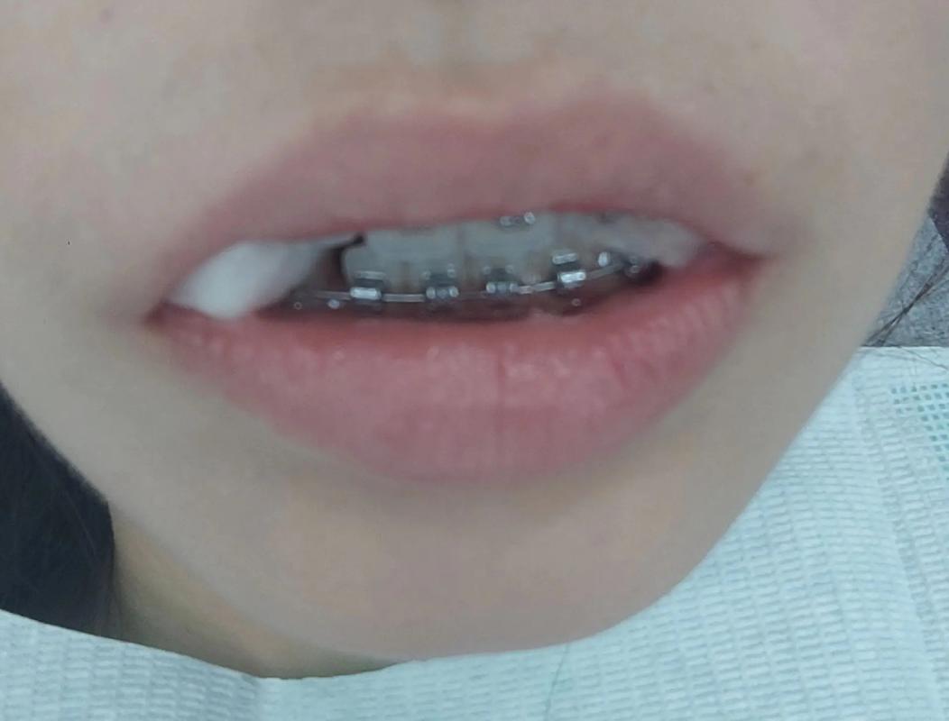 拔牙矫正后牙齿反弹，究竟是什么原因导致的？又该如何有效预防？-图3