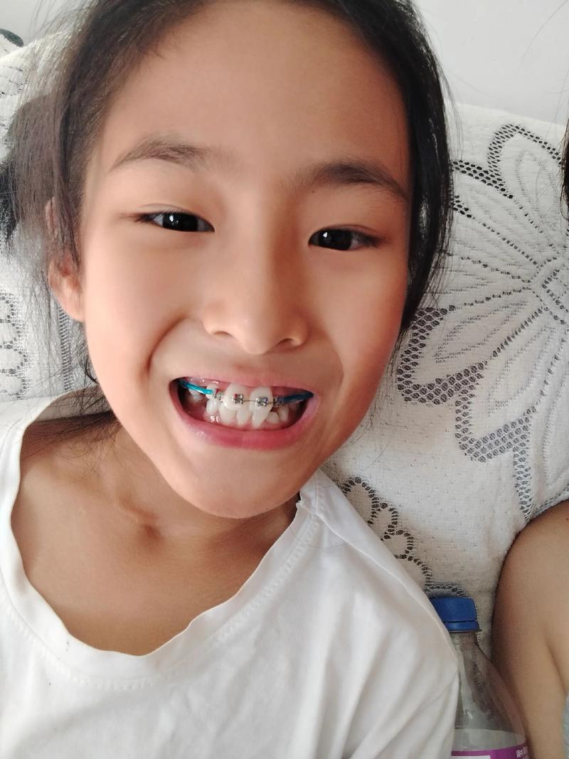 矫正牙齿越早越好?年龄越小矫正效果越佳吗?-图2 矫正牙齿越早越好?年龄越小矫正效果越佳吗?-图2