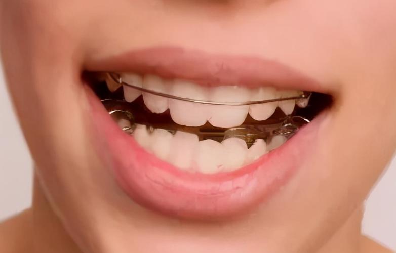 牙齿矫正保持器变形-图2