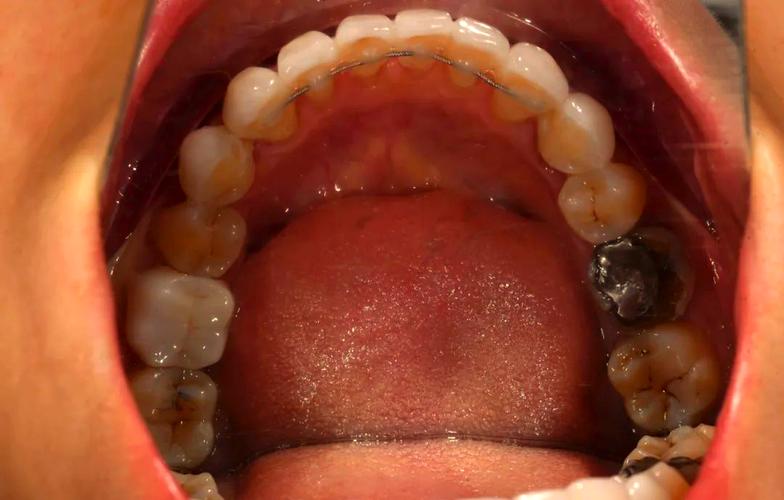 牙齿矫正保持器变形-图3