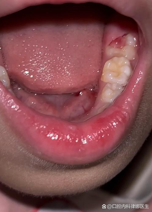 矫正牙齿后牙龈肿痛怎么办？-图1