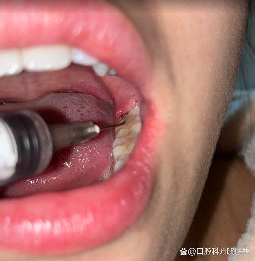 矫正牙齿后牙龈肿痛怎么办？-图3