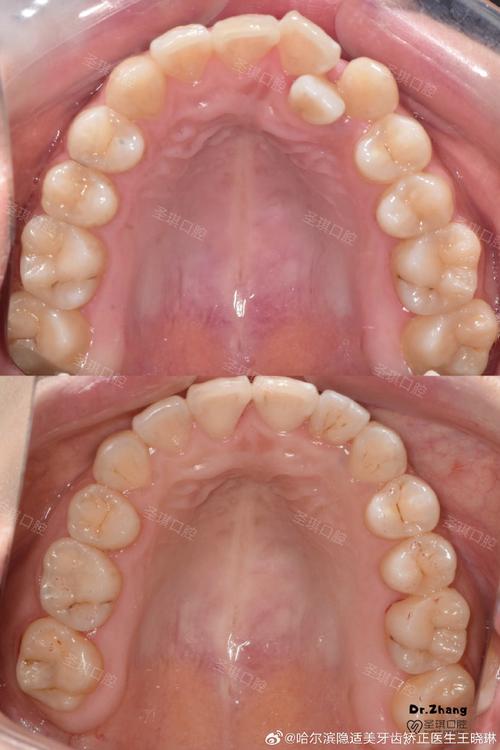 牙齿矫正下牙齿不齐，矫正后没改善怎么办？-图1