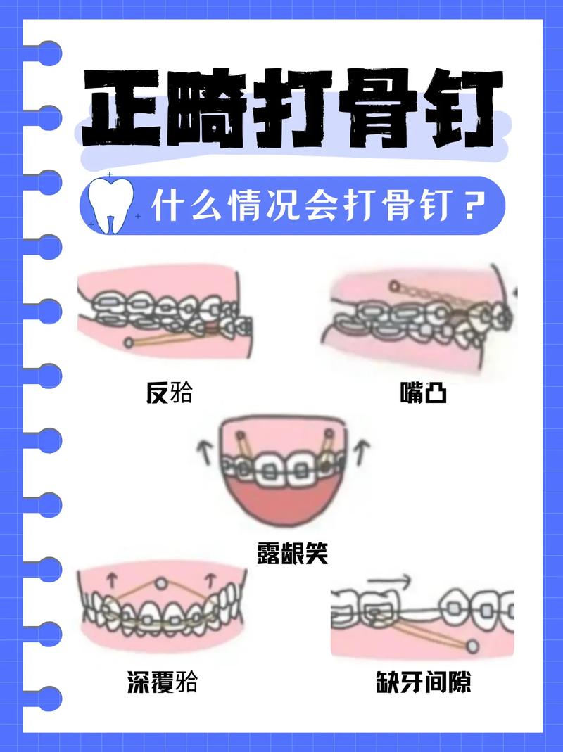 牙齿矫正都要打骨钉吗？什么情况下才需要打？-图3