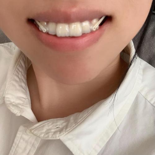 牙齿矫正打骨钉效果究竟如何？真能提升矫正效率与效果吗？-图1