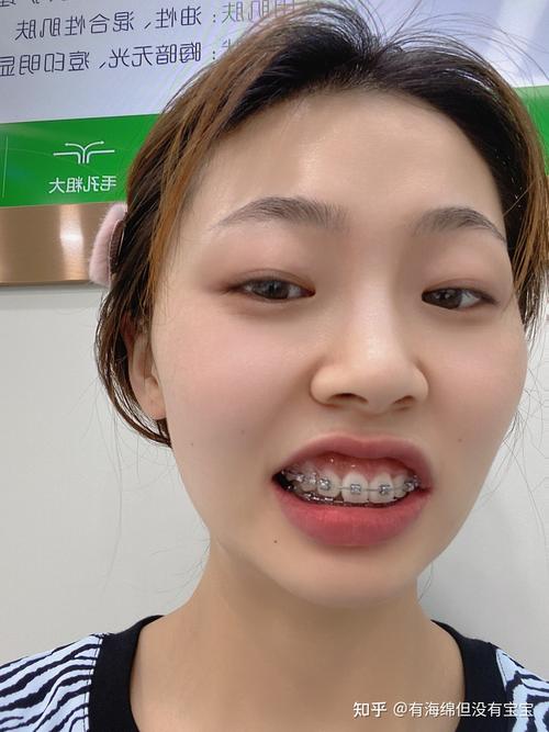 牙齿矫正打骨钉效果究竟如何？真能提升矫正效率与效果吗？-图3