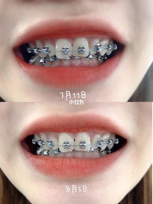 24岁矫正牙齿还来得及吗？-图1