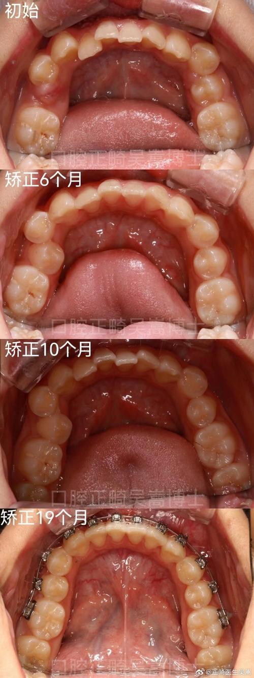 虎牙不拔牙矫正牙齿-图2