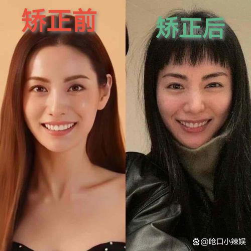 明星不拔牙矫正牙齿真的可行吗?-图1 明星不拔牙矫正牙齿真的可行吗?-图1