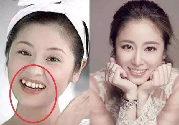 明星不拔牙矫正牙齿真的可行吗?-图3 明星不拔牙矫正牙齿真的可行吗?-图3