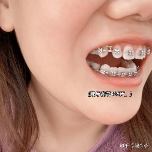 26岁矫正牙齿晚不晚?成年人矫正还来得及吗?-图2 26岁矫正牙齿晚不晚?成年人矫正还来得及吗?-图2