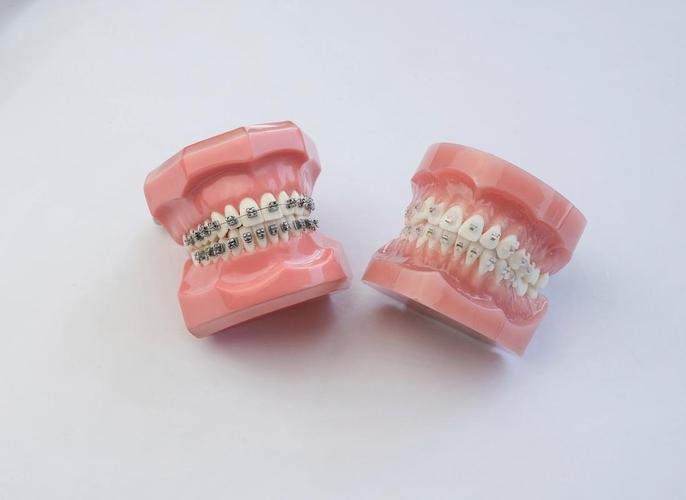 26岁矫正牙齿晚不晚?成年人矫正还来得及吗?-图3 26岁矫正牙齿晚不晚?成年人矫正还来得及吗?-图3