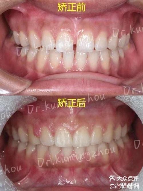 杭州矫正牙齿哪里好?专业机构怎么选?-图3 杭州矫正牙齿哪里好?专业机构怎么选?-图3