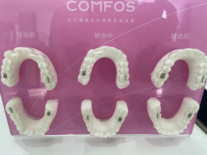 格莱美牙齿隐形矫正效果如何?舒适度和安全性怎么样?-图1 格莱美牙齿隐形矫正效果如何?舒适度和安全性怎么样?-图1