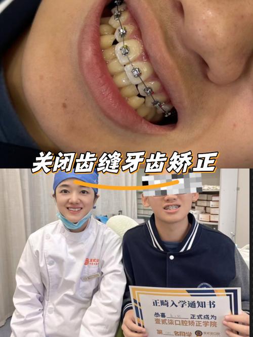 广州大学城牙齿矫正怎么选？学生党性价比方案看这里？-图2