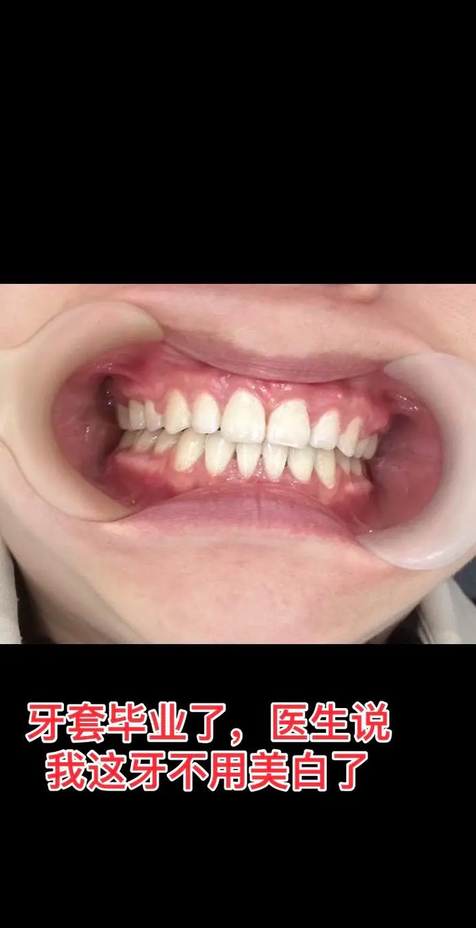 牙齿矫正后牙龈萎缩,矫正过程是诱因吗?-图1 牙齿矫正后牙龈萎缩,矫正过程是诱因吗?-图1