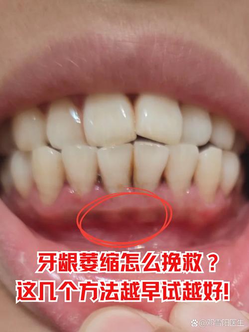 牙齿矫正后牙龈萎缩,矫正过程是诱因吗?-图3 牙齿矫正后牙龈萎缩,矫正过程是诱因吗?-图3