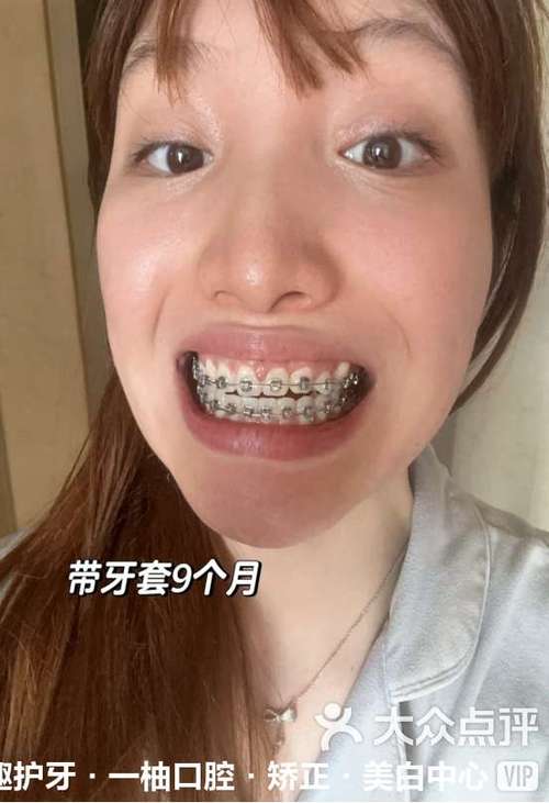 矫正牙齿的人,真的会后悔当初的决定吗?-图2 矫正牙齿的人,真的会后悔当初的决定吗?-图2