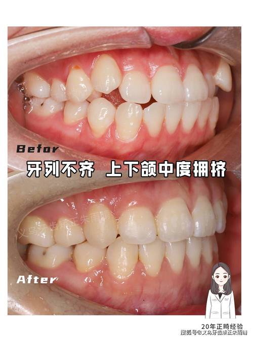 牙齿矫正后咬合不齐，是矫正效果不好吗？-图1