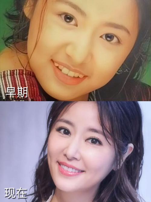 林心如矫正牙齿图片引猜测，为何突然矫正？效果引关注？-图1