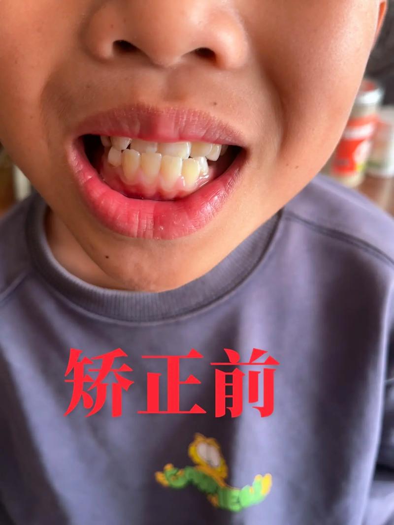 天包地牙齿矫正难度大吗？效果理想吗？需注意什么？-图1