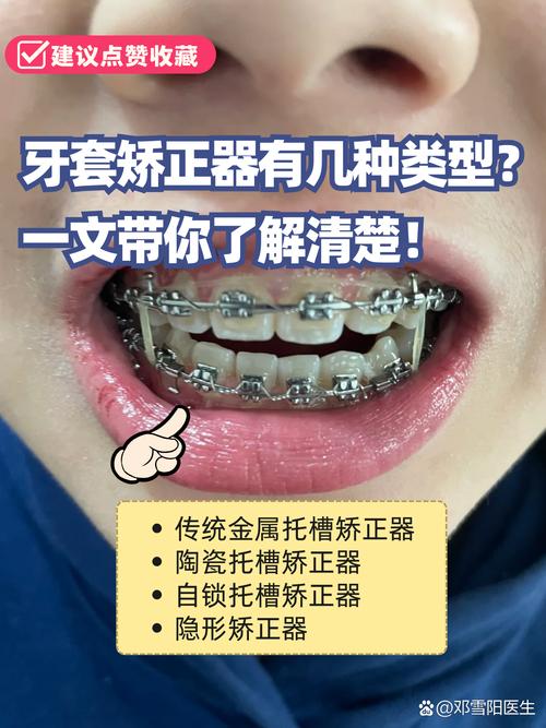 牙齿矫正必须戴牙套？还有其他矫正方式吗？-图3