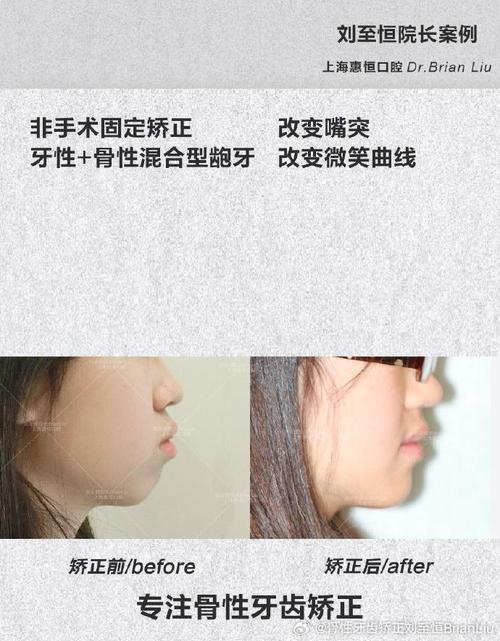 矫正牙齿能改善外凸额畸形吗？-图3