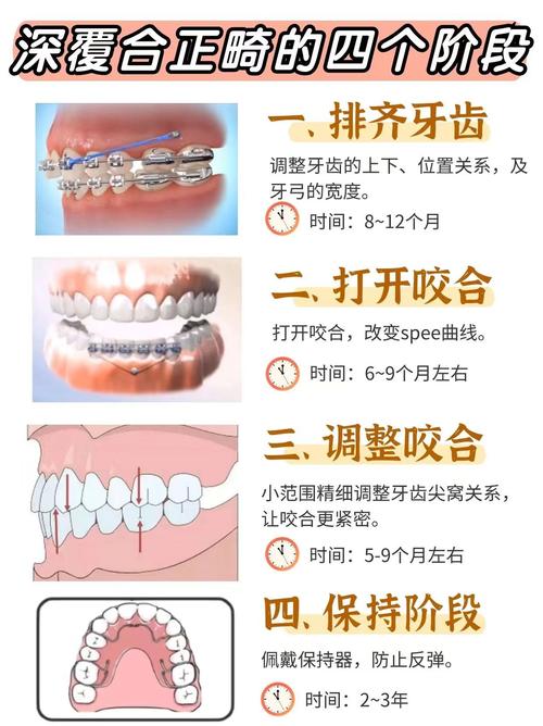 牙齿矫正过程和时间-图2