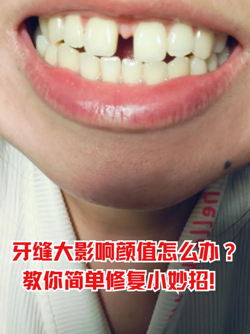 矫正后门牙仍有缝隙?原因和解决方法是什么?-图1 矫正后门牙仍有缝隙?原因和解决方法是什么?-图1