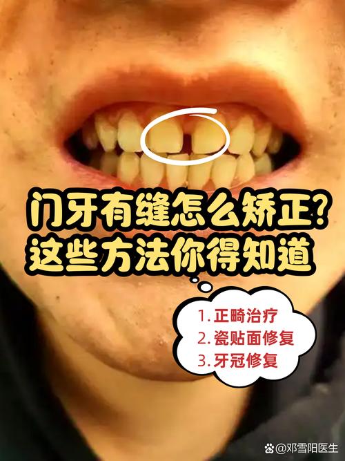 矫正后门牙仍有缝隙?原因和解决方法是什么?-图2 矫正后门牙仍有缝隙?原因和解决方法是什么?-图2