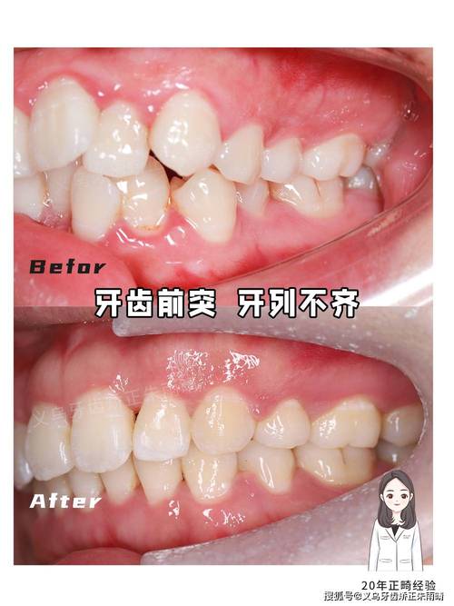 30岁矫正牙齿效果如何？真实案例分享有参考价值吗？-图3