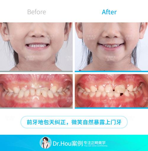 幼儿地包天矫正何时开始最合适?家长必知的方法与时机-图1 幼儿地包天矫正何时开始最合适?家长必知的方法与时机-图1