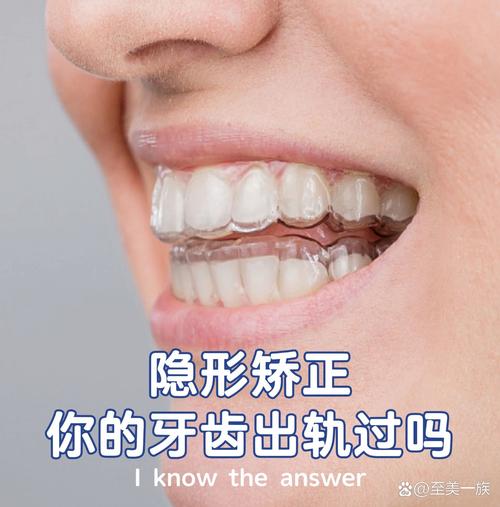 半隐形矫正牙齿图片-图2