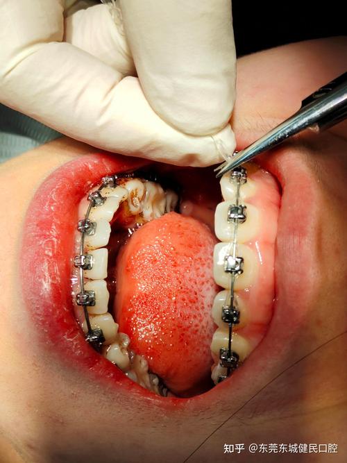 东莞牙齿矫正哪家好？求推荐技术好又价格合理的机构！-图2