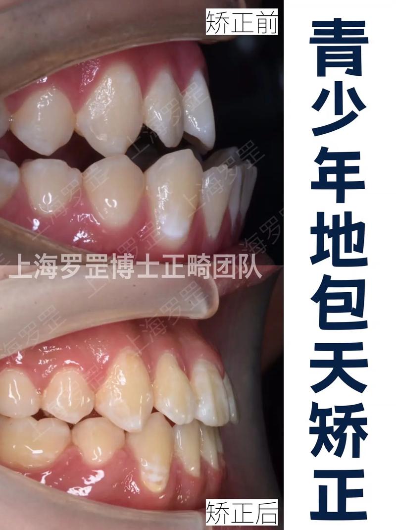 上海青少年牙齿矫正-图1