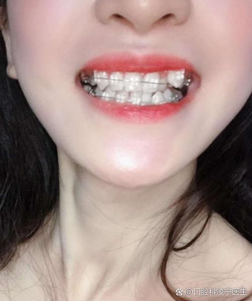 成人牙齿矫正有效果-图2 成人牙齿矫正有效果-图2