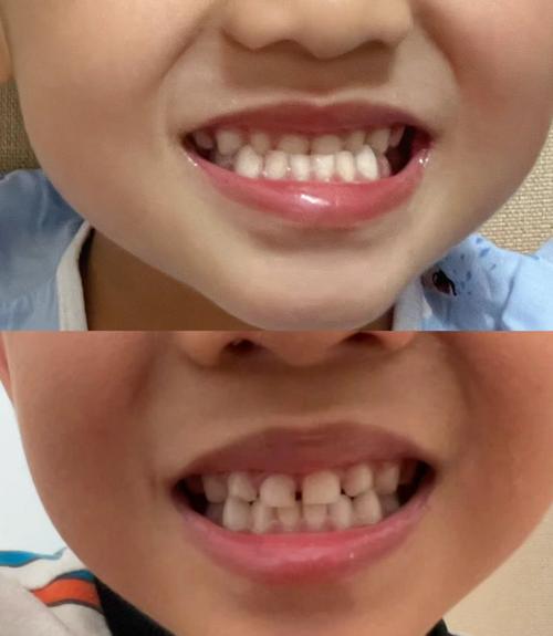 小孩地包天矫正什么时候开始最合适？-图2