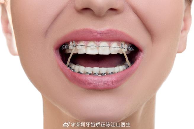 深圳矫正牙齿哪家好？医院怎么选？-图3